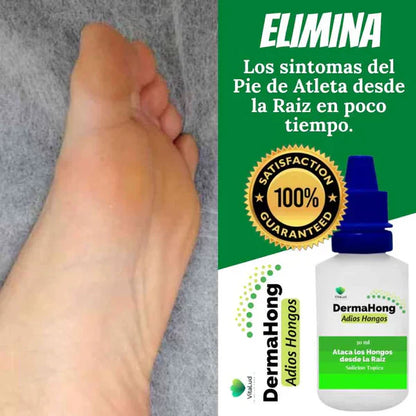 DermaHong Pro™ – Dile Adiós a los Hongos disminuye en 15 Días 🔥 Producto en tendencia